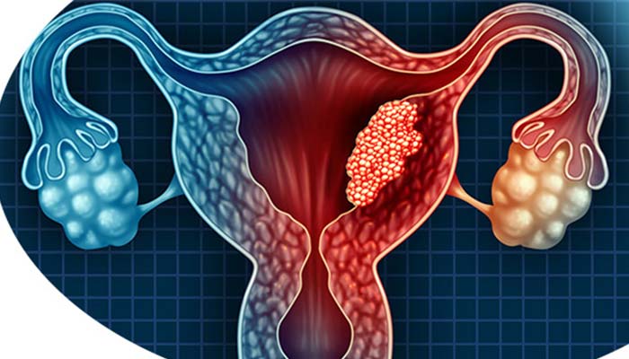 عواض سرطان رحم