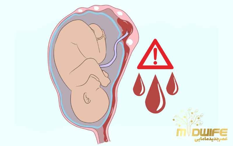 انواع خونریزی در بارداری و دلایل آن 1 انواع خونریزی بارداری دلایل اولیه