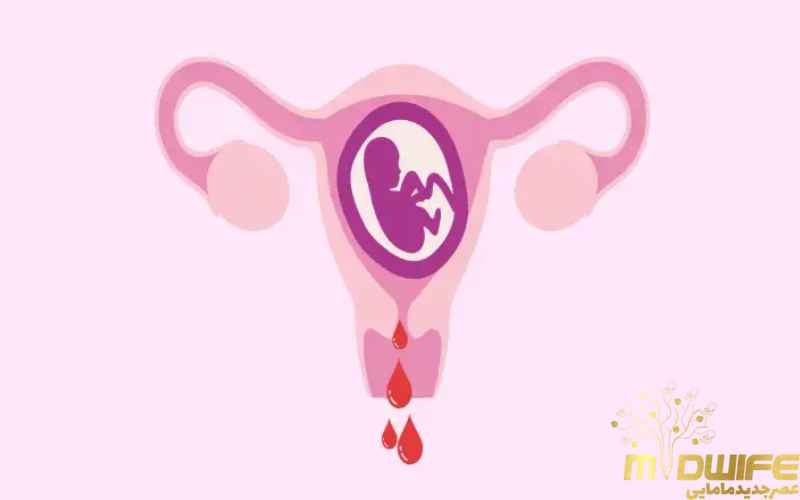 دلایل خونریزی در بارداری