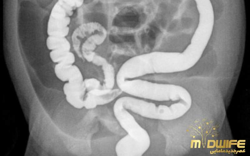 مراقبت بعد از عمل انسداد روده نوزاد (Neonatal Intestinal Obstruction) 4 Neonatal Intestinal Obstruction