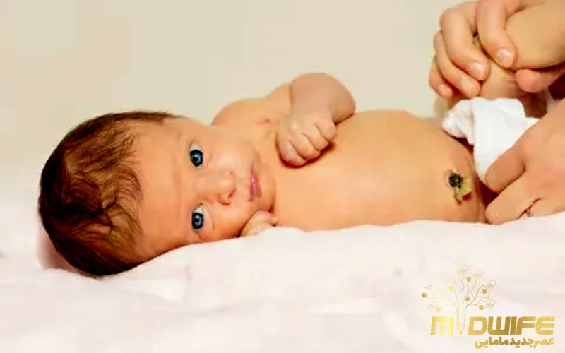 مراقبت از ناف نوزاد بعد از افتادن 1 افتادن بند ناف نوزاد
