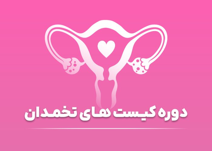 دوره کیست تخمدان